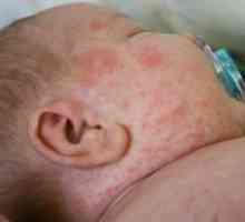 Алергиски осип кај дете