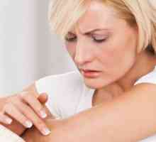 Атопичен дерматитис - Симптоми и третман кај возрасни