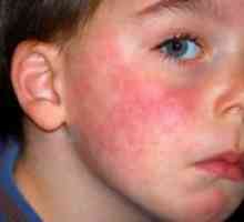 Алергии кај децата - како да се третираат?