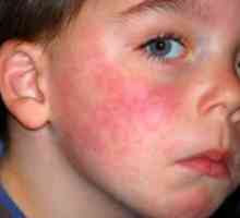 Симптомите на алергии кај децата