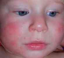 Атопичен дерматитис кај деца - третман