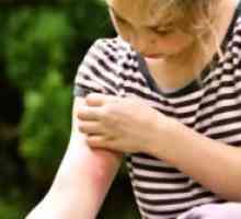 Како да се третираат каснување од комарец дете?