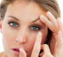 Акни очи - Симптоми и лекување