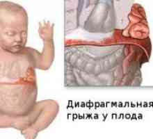 Дијафрагмална хернија во новороденчињата
