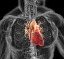 Дилатациона кардиомиопатија