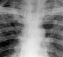 Дисеминирана туберкулоза