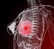 Бенигни тумор на дојка - третман