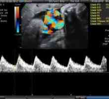 Doplerometrii за време на бременоста