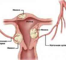 Матката fibroids