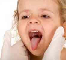 Herpangina кај децата - Третман
