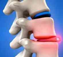 Рбетниот хернија - Симптоми и лекување