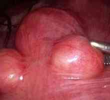 Интерстицијална subserous матката fibroids