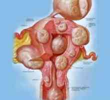 Интрамурална матката fibroids