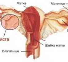 Корпус на матката Ендометриоза