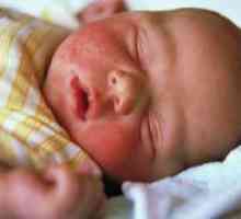 Како да се третираат дијатеза на образите кај бебињата?