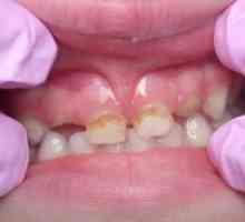 Кариес млечните заби