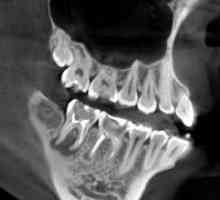 Компјутеризирана томографија на забите
