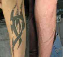 Ласерско отстранување на тетоважа