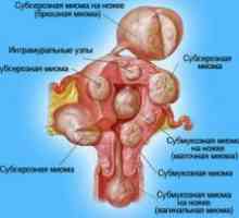 Матката fibroids - третман на народни лекови