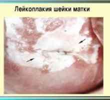 На грлото на матката леукоплакија - Симптоми