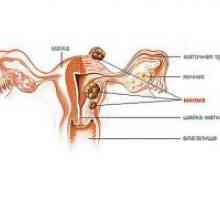 Матката fibroids мали димензии