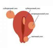 Матката fibroids - Причини