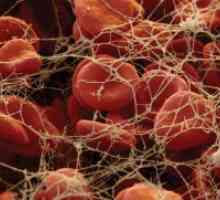 Ниско ниво на тромбоцити во крвта - причина