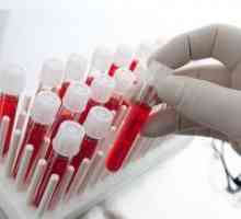 Вкупниот билирубин - Стапката на крв кај жените