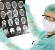 Тумор на мозокот - симптоми во раните фази