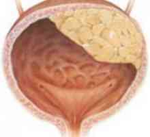 Тумор на мочниот меур