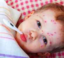 Симптоми на мали сипаници кај децата