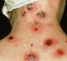 Симптоми на сифилис кај жените