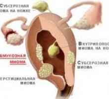 Субмукозни матката fibroids - третман