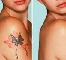 Ласерски отстранување на тетоважа