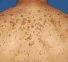 Видови на пигментирани дамки на кожата и нивниот третман