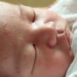 Акни на новородени