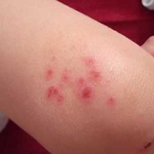 Атопичен дерматитис кај деца