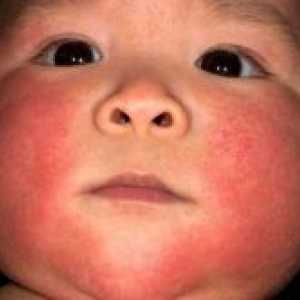 Атопичен дерматитис кај доенчиња