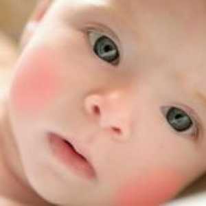 Алергични на леќата кај доенчиња
