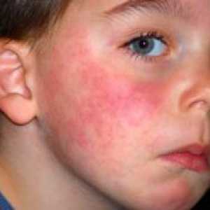 Симптомите на алергии кај децата