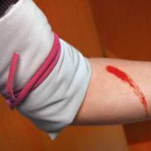 Артериски крварење