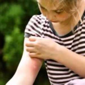 Како да се третираат каснување од комарец дете?