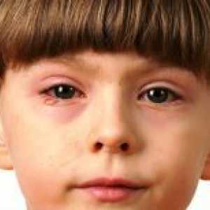 Измијте ги очите со конјуктивитис кај децата?