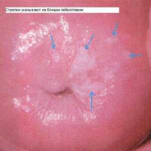Што е грлото на леукоплакија и колку опасно е тоа?