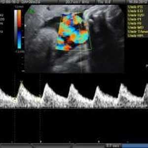 Doplerometrii за време на бременоста