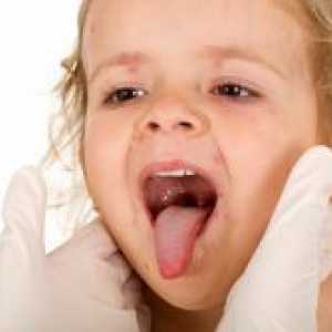 Herpangina кај децата - Третман