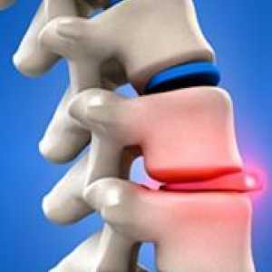 Рбетниот хернија - Симптоми и лекување