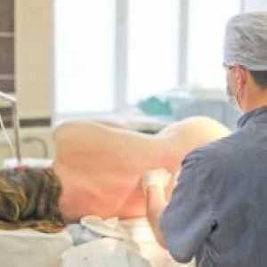 Епидуралната анестезија при царски рез