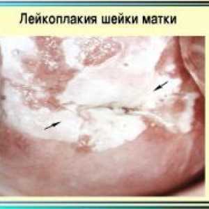 На грлото на матката леукоплакија - Симптоми
