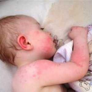 Маст од алергии за деца